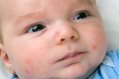 Obat Alergi Anak yang Ada di Sekitar Kita